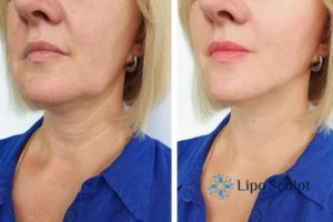 Double chin before and after Hi-Fu treatment 4 Book your double chin treatment Boston today! We are here to help!
