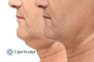 Double chin before and after Hi-Fu treatment 2 Double chin treatment Boston from Lipo Sculpt - feel more confident today!