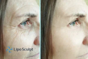 How to Fight Aging Symptoms 2 Do you want to Fight Aging Symptoms Boston? Contact Lipo Sculpt today!