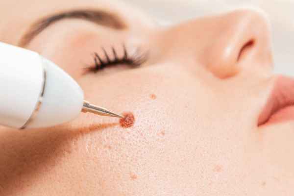 CryoPen: 5 Skin Concerns It May Be Used to Treat 3 What actually happens during a CryoPen treatment Boston?