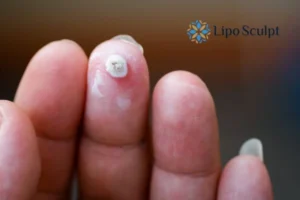 Cryopen Top 5 Treatable Conditions 4 Do you have a persistent wart of verruca that you cannot shit? Cryopen Boston treatment will work call us NOW!