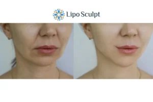 Explaining Total Skin Tightening Treatment And What It Can Do For You 2 Do you want to boost your self confidence? Give Morpheus8 Boston a try today!