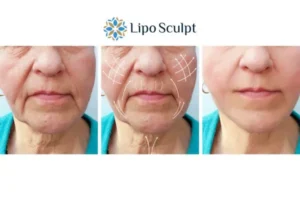Explaining Total Skin Tightening Treatment And What It Can Do For You 3 Boost your confidence with Morpheus8 Boston call our team today!