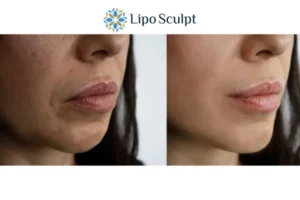 Explaining Total Skin Tightening Treatment And What It Can Do For You 4 Morpheus8 Boston the best results - call our team today!