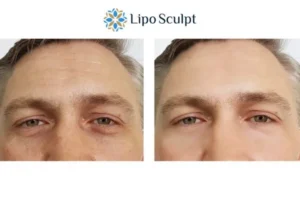 Explaining Total Skin Tightening Treatment And What It Can Do For You 6 Morpheus8 Boston book in today to find out more!