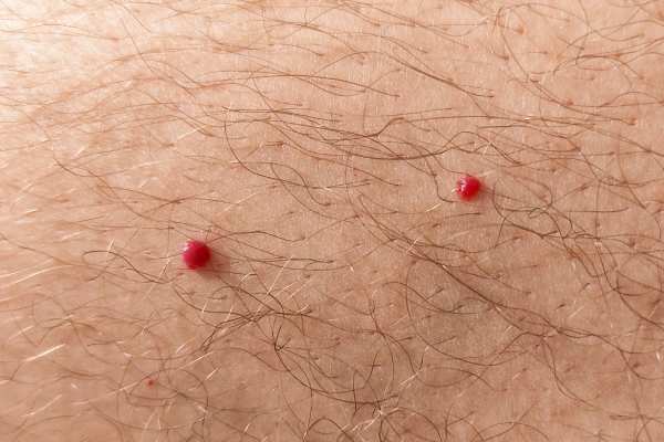 CryoPen: 5 Skin Concerns It May Be Used to Treat 2 cherry angioma removal Boston