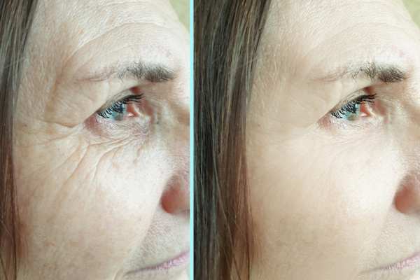 Why Do People Choose HIFU for a Non-Surgical Facelift? 4 How long can HIFU results last Boston?
