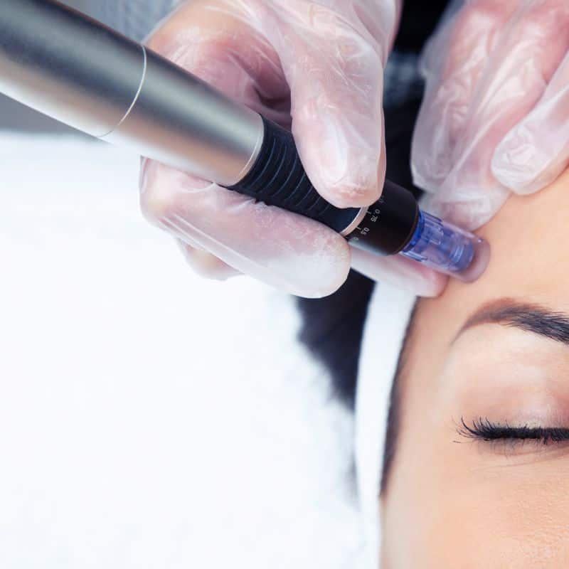 Morpheus8 treatment Boston from Lipo Sculpt - Book in today!