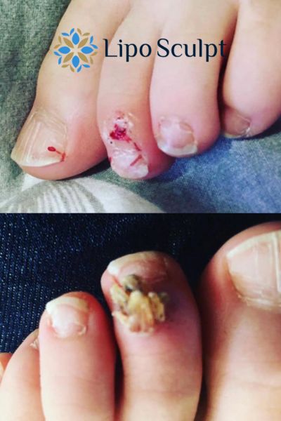 Wart removal customer results from Lipo Sculpt Boston