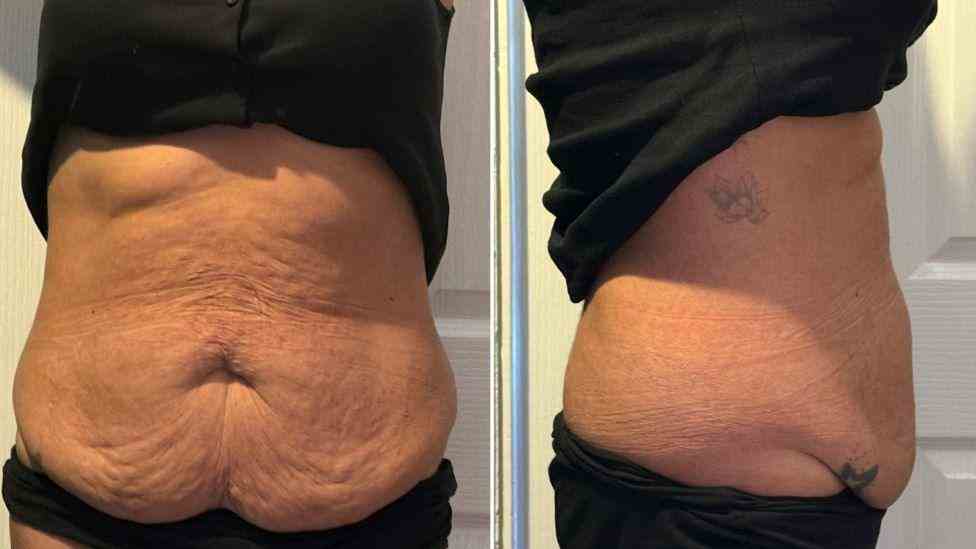 Lost the Weight but Not the Loose Skin? What You Should Know 1 Is It Definitely Loose Skin Boston?